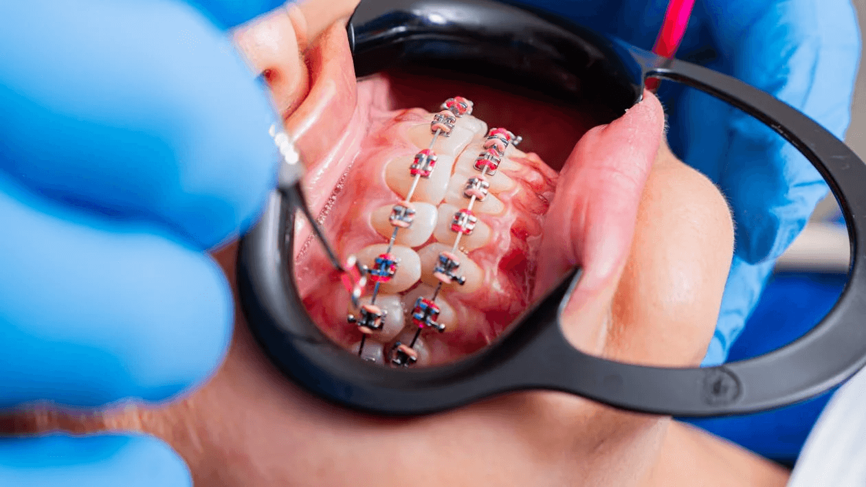 Clips vs Braces: Which Treatment is Best for You?