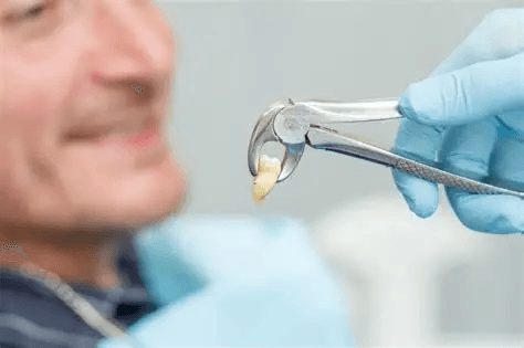 Painless Tooth Extraction: Safe and Comfortable Dental Care