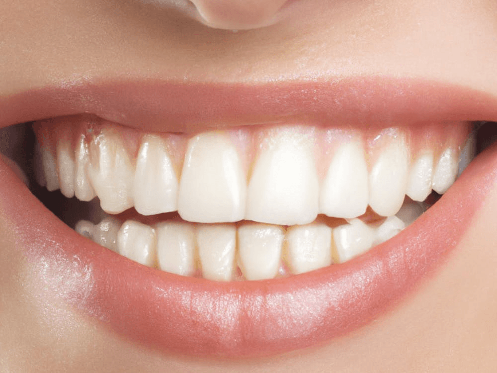 Smile Designing for Confidence