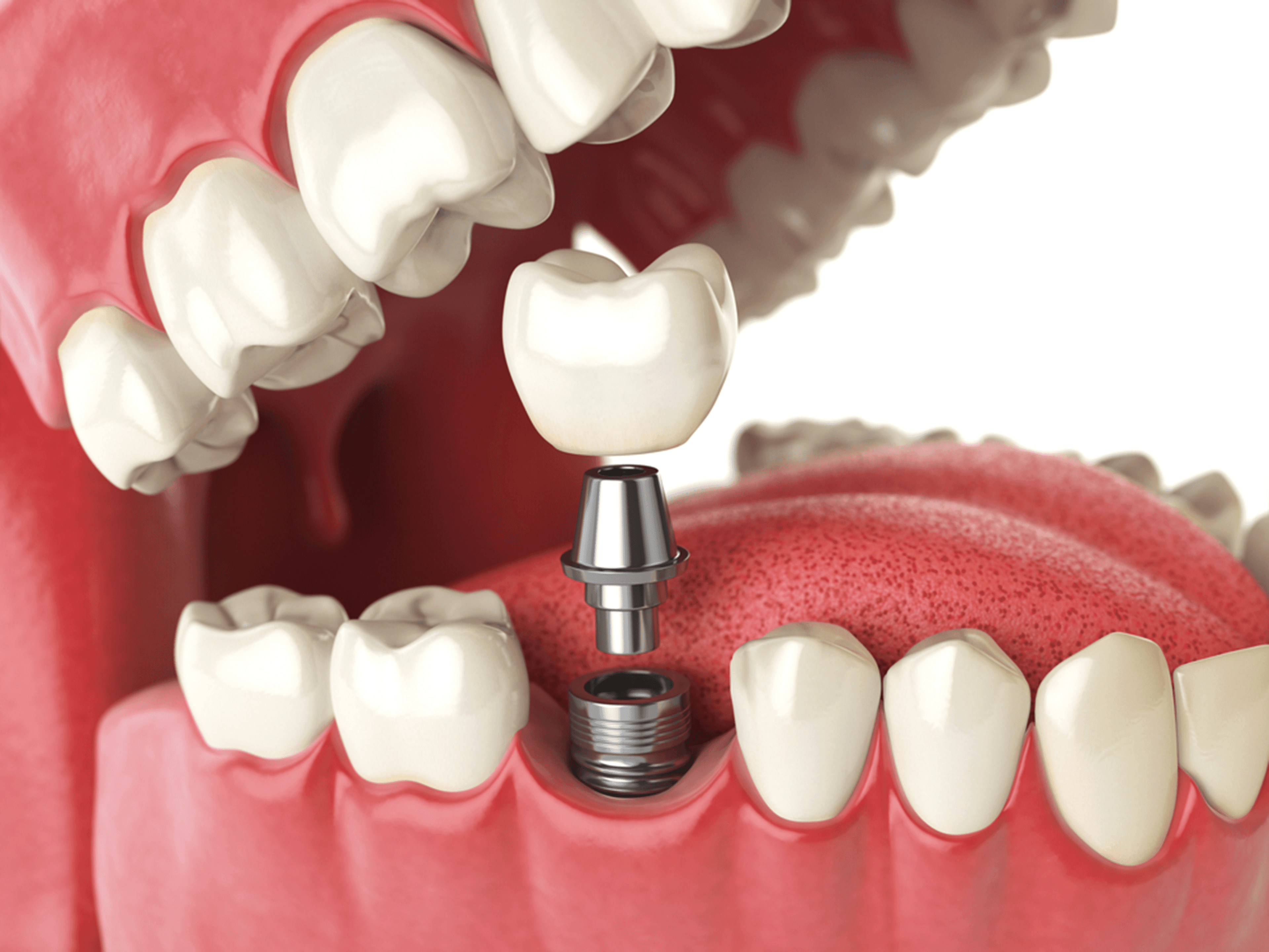 Advanced Dental Implants