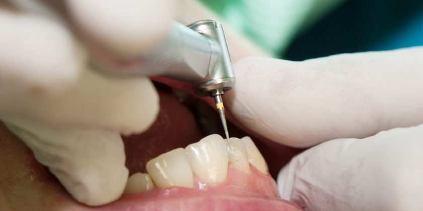Cosmetic Fillings