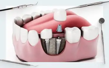 Dental Implants