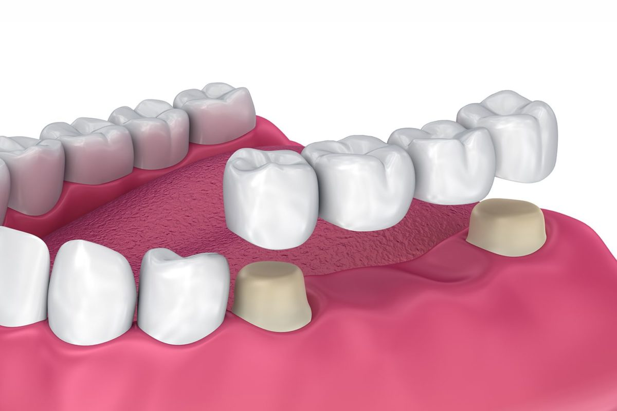 FPD (Fixed Partial Dentures)