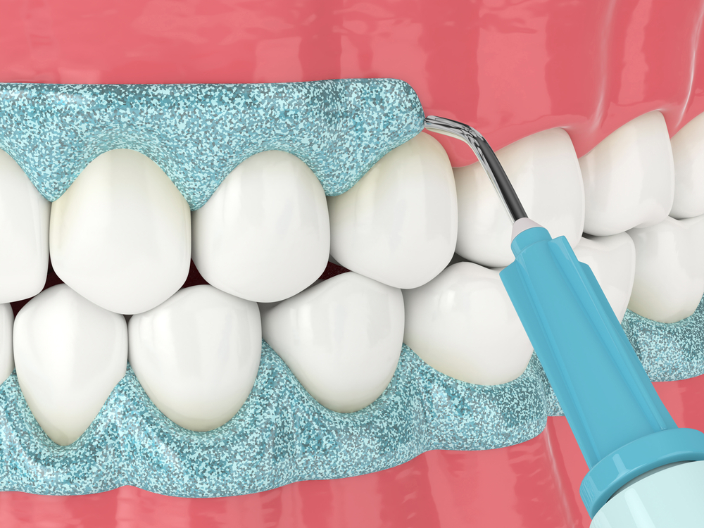Gum Depigmentation
