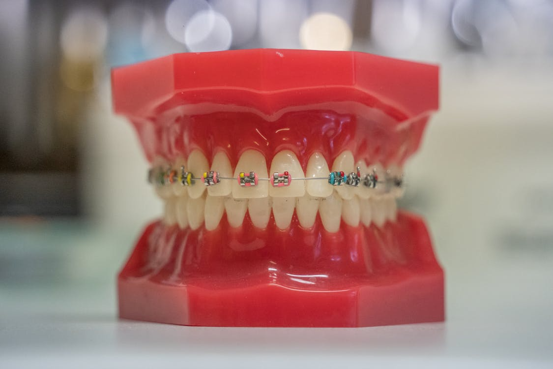 Metal Braces