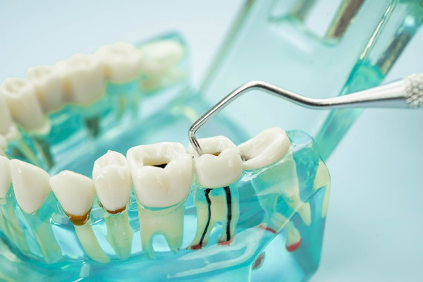 Root Canal Treatment